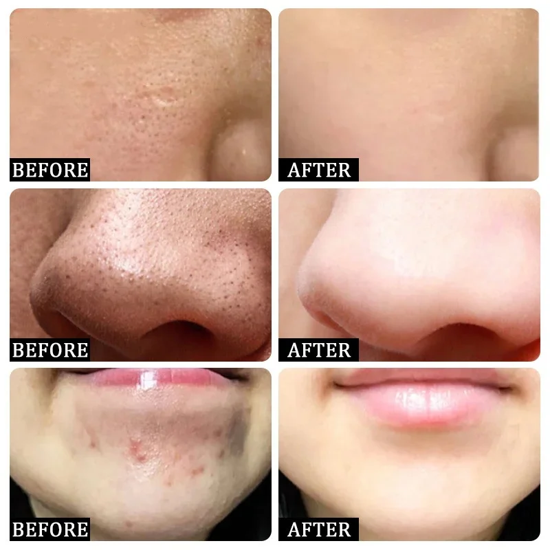Salisilik Asit Gözenek Temizle - Salicylic Acid Blackhead Remover incelemesi ve fiyatı