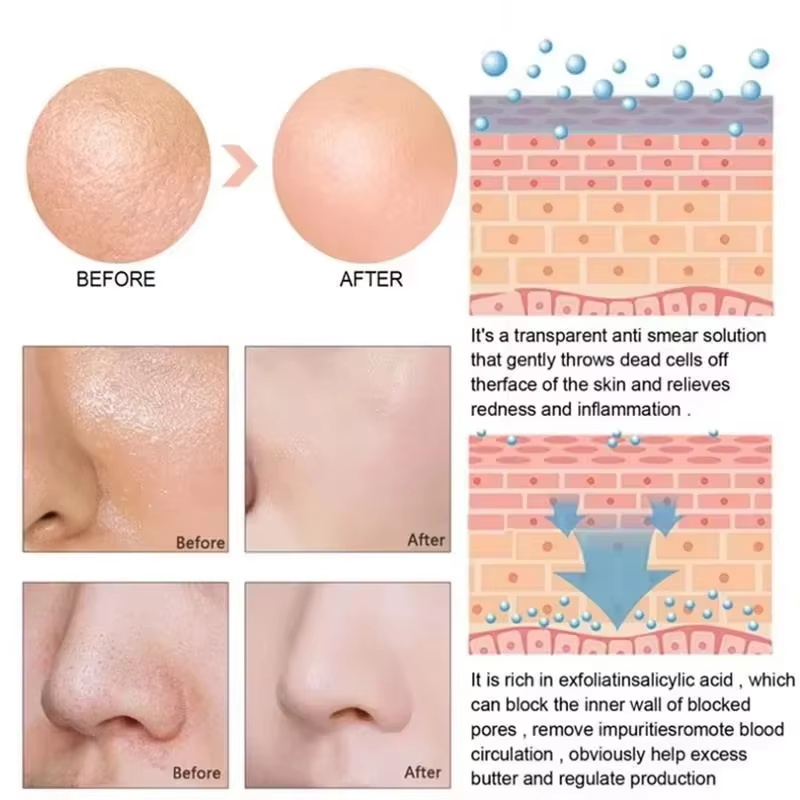 Salisilik Asit Gözenek Sıkılaş - Salicylic Acid Blackhead Remover incelemesi ve fiyatı